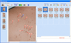 Meloma lunares control