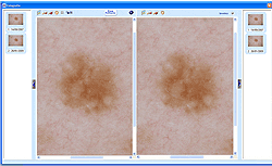 Lunares melano seguimento